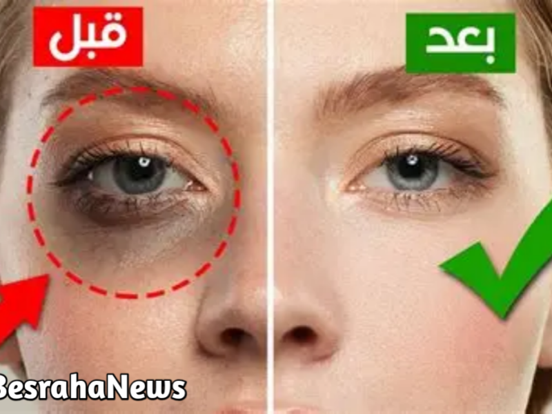 خطوات علاج الهالات السوداء الشديدة